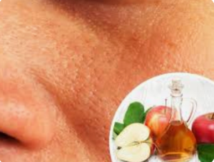 عيوب البشرة