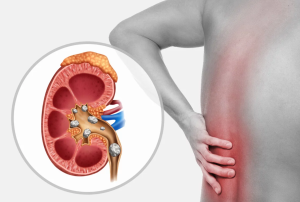 حصى الكلى . الاسباب والعلاج
